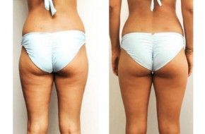  BANISH CELLULITE WITH THE AMAZING BODY BALLANCER.